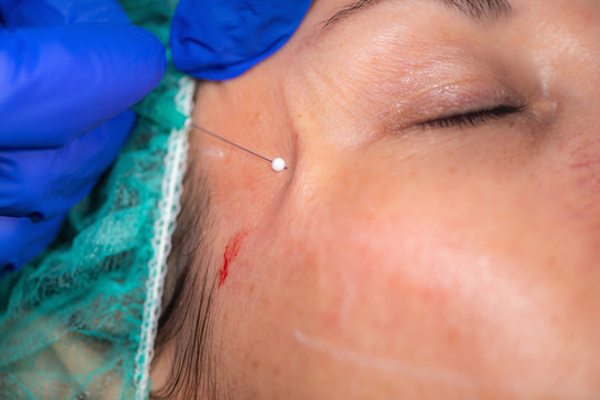 Microinject Needle รูปภาพMicroinjection – เลือกดูภาพถ่ายสต็อก เวกเตอร์ และวิดีโอ154 ...
