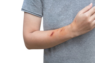 The wound form scabs on hand and arm. The wound happen during woman Injuries from falling down on road.