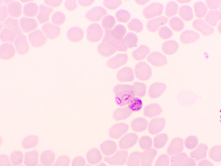 Malaria parasite in red blood cells, ring form stage of Plasmodium falciparum, original magnification 1000x