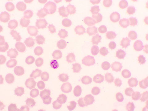 Malaria parasite in red blood cells, ring form stage of Plasmodium falciparum, original magnification 1000x