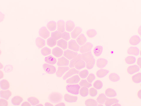 Malaria parasite in red blood cells, ring form stage of Plasmodium falciparum, original magnification 1000x
