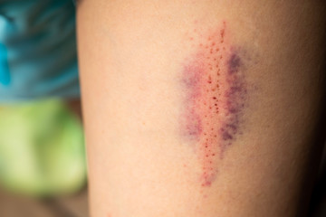 A close-up shot of bruises.