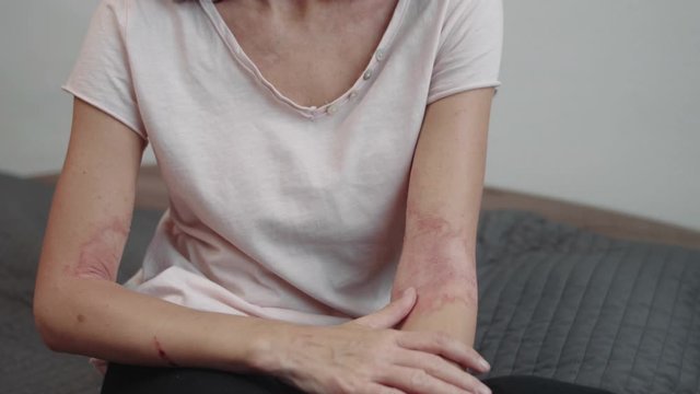 atopic dermatitis on the arms