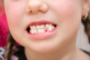 The girl just pulled out her baby teeth. Children's smile after visiting the dentist. A wound in a child's mouth without one tooth is close-up.