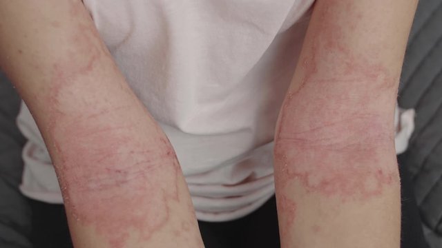 allergic dermatitis on the elbows