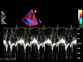 Screen of echocardiography (ultrasound) machine.