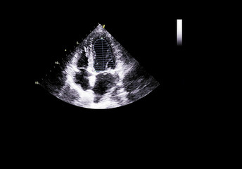 Screen of echocardiography (ultrasound) machine.