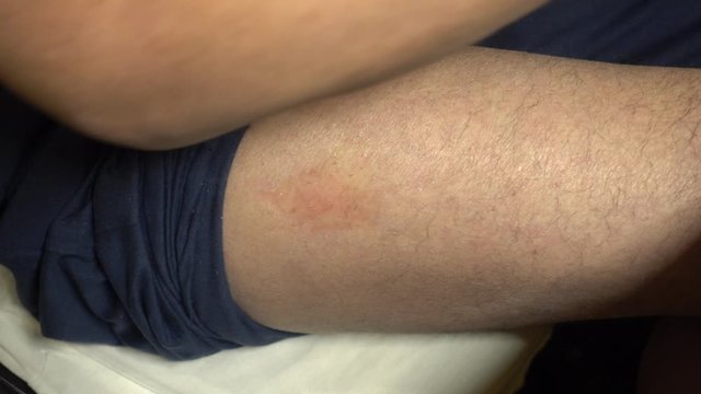 Alcohol wipe cleaning subcutaneous injection site upper thigh. Checking for self-injection.