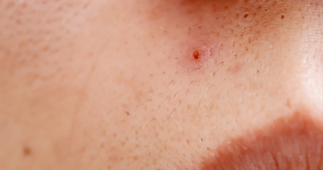 acne on the woman face