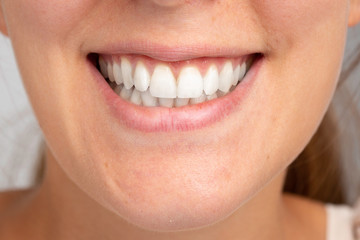 Conceptual image of girl grinding her teeth because of bruxism