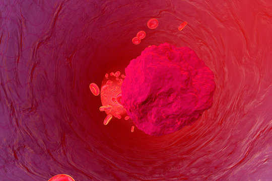 3D rendered Illustration, Mutated leukemia cell in the blood stream