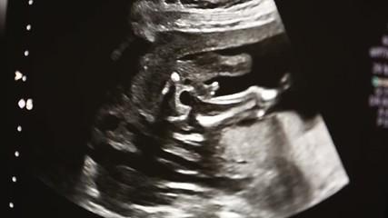 Ultrasound machine screen with unborn baby heart on it