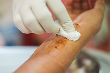 Hands of woman. Stitches that are being treated