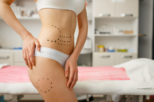 Female patient with markers on her abdomen, botox