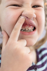 Adult permanent teeth coming in front of the child's baby teeth: shark teeth.