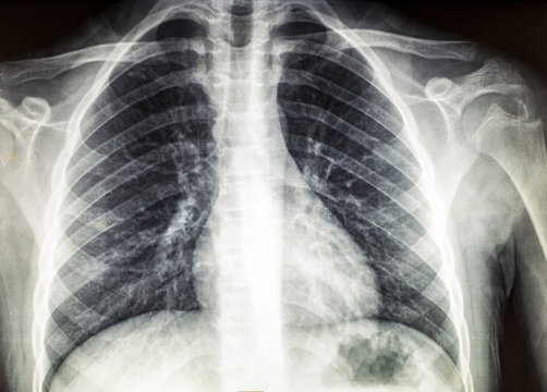 X-ray of the rib cage