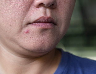 Obraz premium acne skin