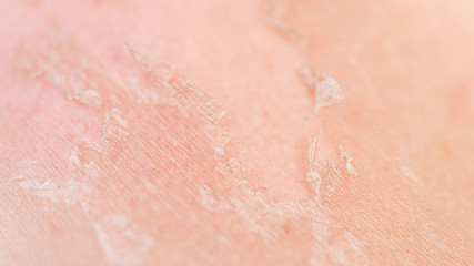 Sunburns of body closeup. Skin damaged by sun, peeling. Body care theme