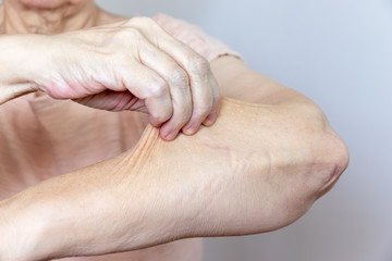 A senior elderly woman holding, pulling the skin on her arm with bad turgor, exces loose skin