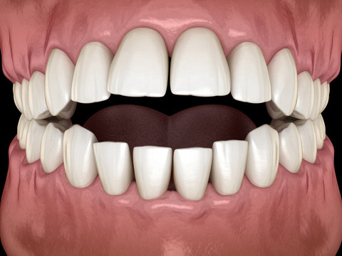Openbite dental occlusion ( Malocclusion of teeth ). Medically accurate tooth 3D illustration