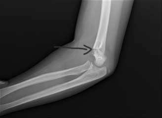 radiography of the elbow joint with a fracture of the shoulder condyles, traumatology and...