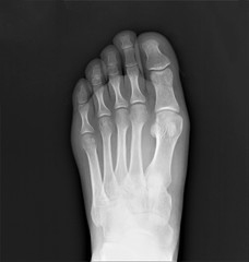 normal radiography of the foot, medical diagnostics, traumatology and orthopedics