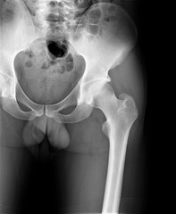 radiograph of the hip joint,medicine,diagnostic,ottopedia