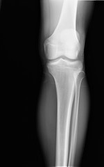 normal radiography of the knee joint in lateral projection, medical diagnostics, traumatology and orthopedics