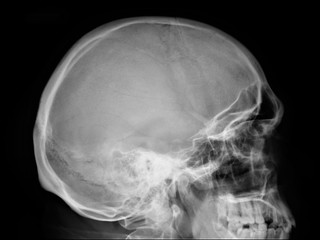 normal x-ray of the skull in lateral projection