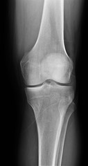 normal radiography of the knee joint in lateral projection, medical diagnostics, traumatology and orthopedics