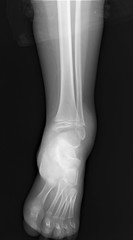 normal radiograph of the ankle joint