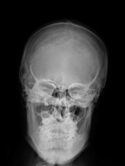 normal x-ray of the skull in direct projection