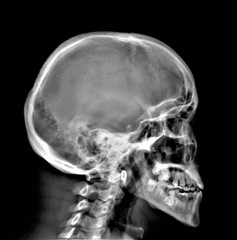 normal x-ray of the skull in lateral projection