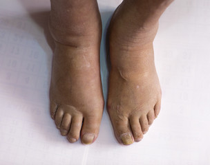 Fototapeta premium swollen legs with fungal infection isolated on white background