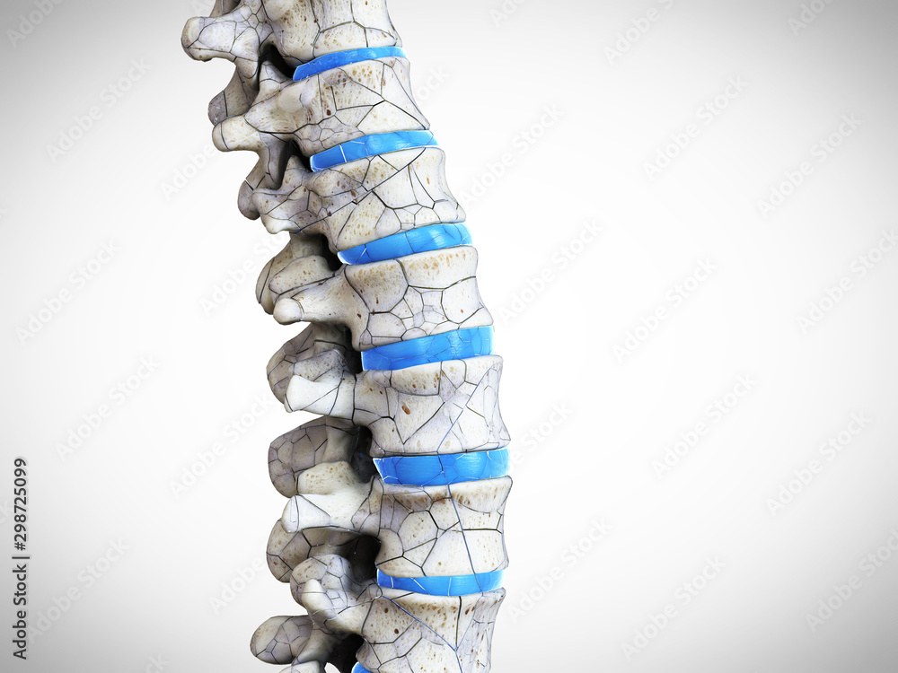 Wall mural 3d rendered medically accurate illustration of a broken spine