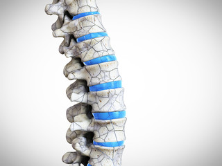 3d rendered medically accurate illustration of a broken spine