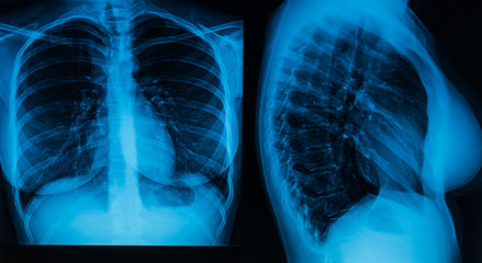 A woman's chest x-ray in two projections