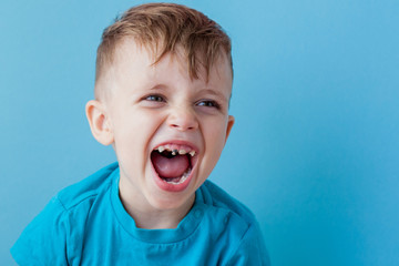 Extensive early dental caries and misaligned and spare incisor teeth in upper jaw © volody10