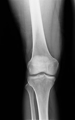 normal radiography of the knee joint in lateral projection, medical diagnostics, traumatology and orthopedics