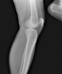 normal radiography of the knee joint in lateral projection, medical diagnostics, traumatology and orthopedics