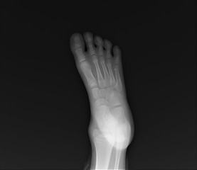 normal radiography of the foot, medical diagnostics, traumatology and orthopedics