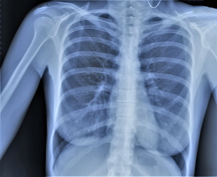 normal radiography of the chest and lungs,pulmonology, medical diagnostics