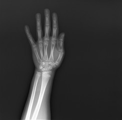 normal x-ray of the hand bones and fingers,orthopedics, medical diagnostics, rheumatology