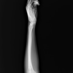 normal radiography of hand and wrist bones, traumatology and orthopedics, traumatology, sports injury