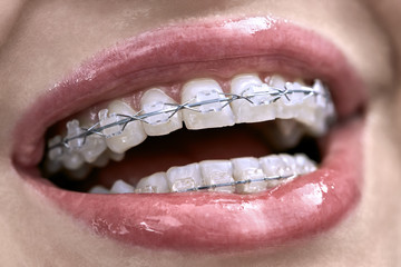 Closeup view at female teeth with bracket system