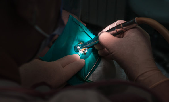 tdentistry. dental treatment, close-up. teeth and caries.