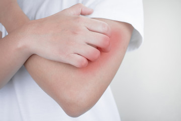 Close up, hands scratching arms from itching, insect bites, skin on a white background. Health care concept.