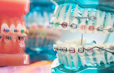 Close up dentist tools and orthodontic model  - demonstration teeth model of varities of...