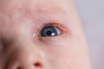 A close up of a young baby with a common sore sticky eye infection