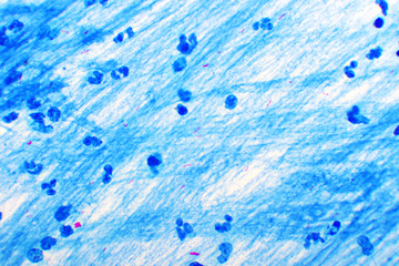 Acid-fast bacilli positive (small red rod) in sputum smear, analyze by microscope, specimen from...